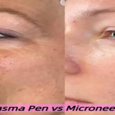 Plasma Pen vs Microneedling Pick the Best Option