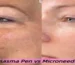 Plasma Pen vs Microneedling Pick the Best Option